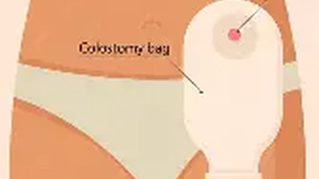 Stoma Care Awareness